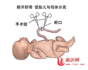 新生儿脐带护理